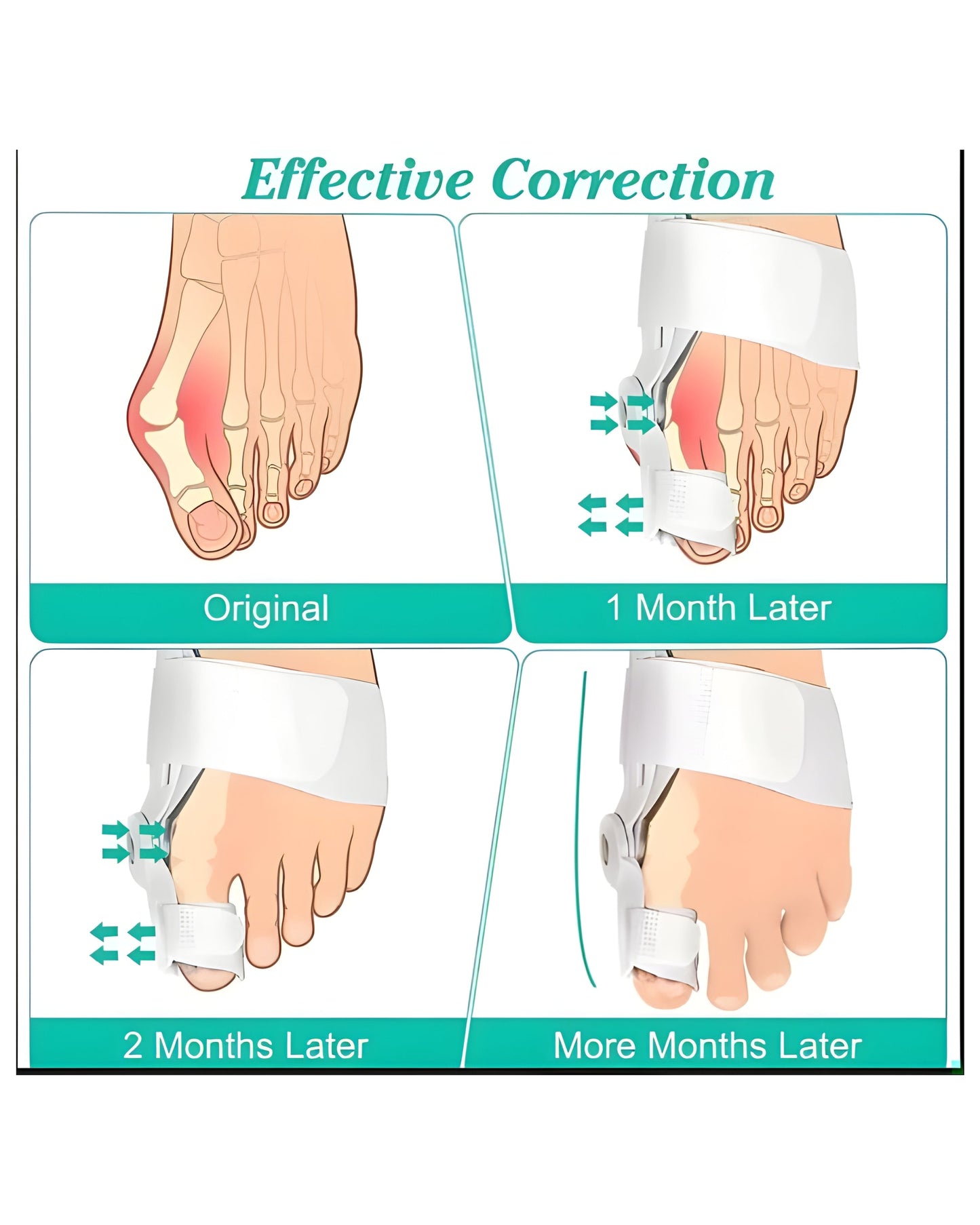 MacMonte™ | Toe Corrector for Natural Alignment