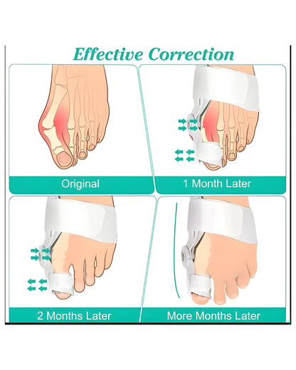 MacMonte™ | Toe Corrector for Natural Alignment